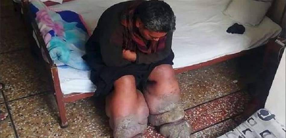 في حادثة مرعبة.. بعوضة تصيب رجلاً بداء الفيل! (فيديو)