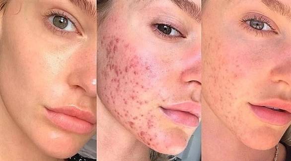 بالتفاصيل.. هذه الحمية الغذائية تخلّصكم نهائياً من حب الشباب
