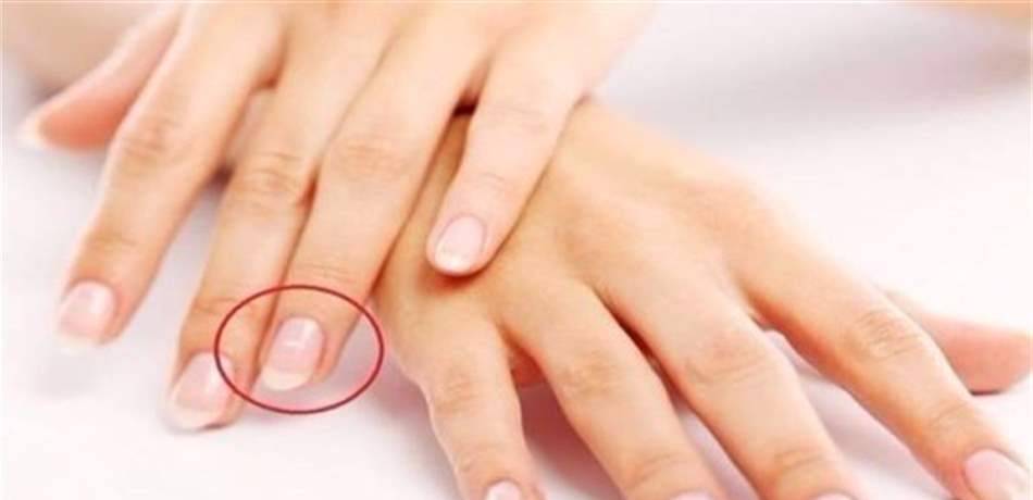 قد تدلّ على مرض بالقلب.. لماذا تظهر بقع بيضاء على الأظافر؟