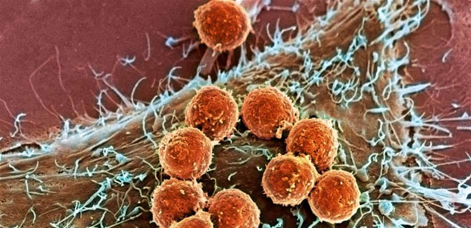 اكتشاف رابط بين جراحة تجميلية وسرطان نادر!