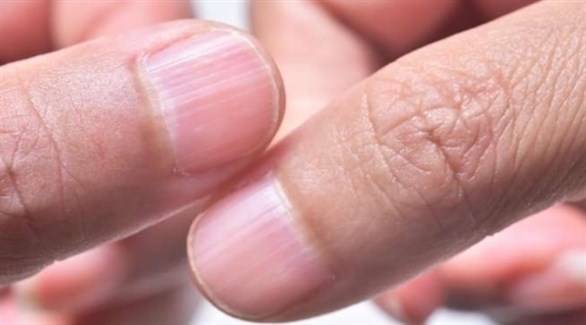 ماذا تعني خطوط الأظافر؟