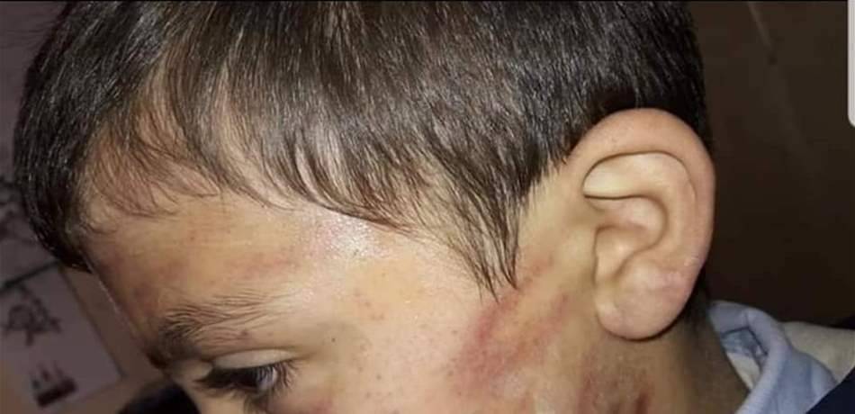في طرابلس.. الطفل "هادي" ضحية والد بلا قلب: ضربه بشكل وحشي! (صور)