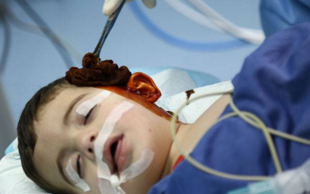 عمليّة فريدة من نوعها لزراعة قوقعة الطفل
