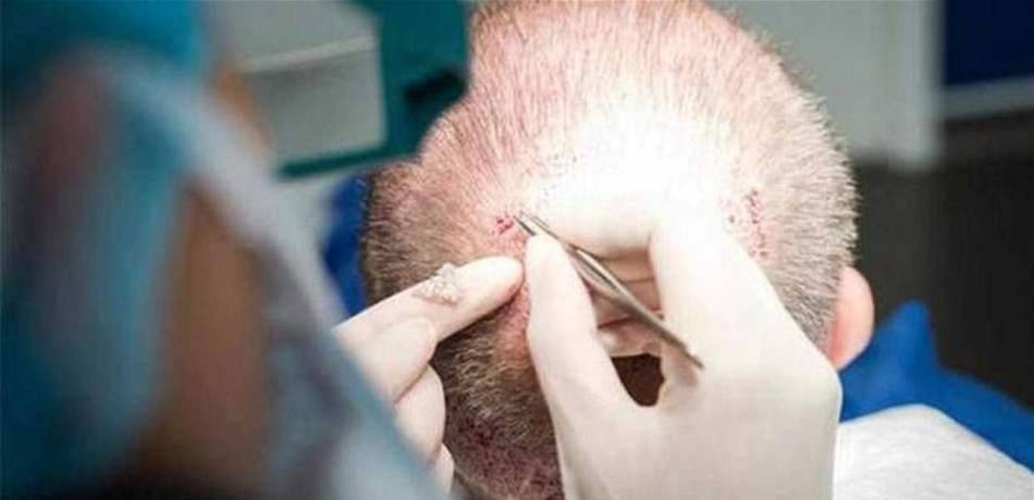 توفي بعد عملية زراعة شعر استمرت 12 ساعة!