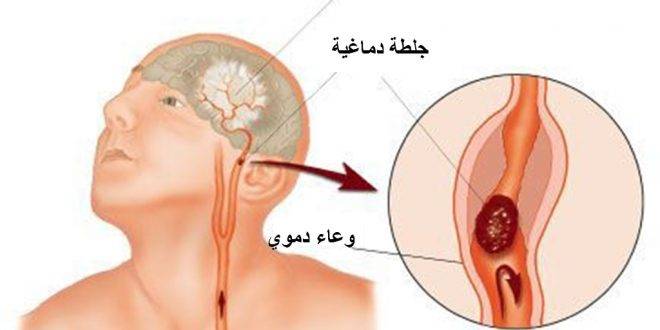 الجلطة الدماغية: 4 حيل تُنقذ حياتك وحياة غيرك۔۔۔ تعرف عليها!