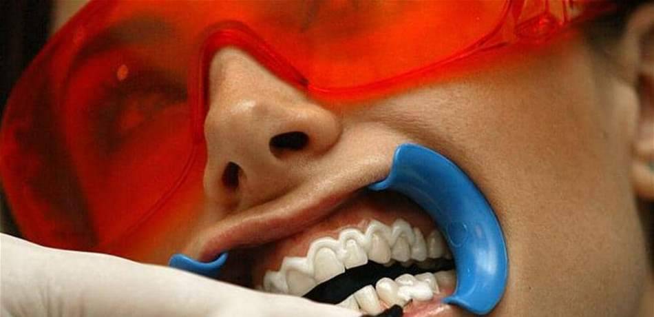 إذا قرأتم هذا الخبر.. لن تجرّبوا تبييض الأسنان!