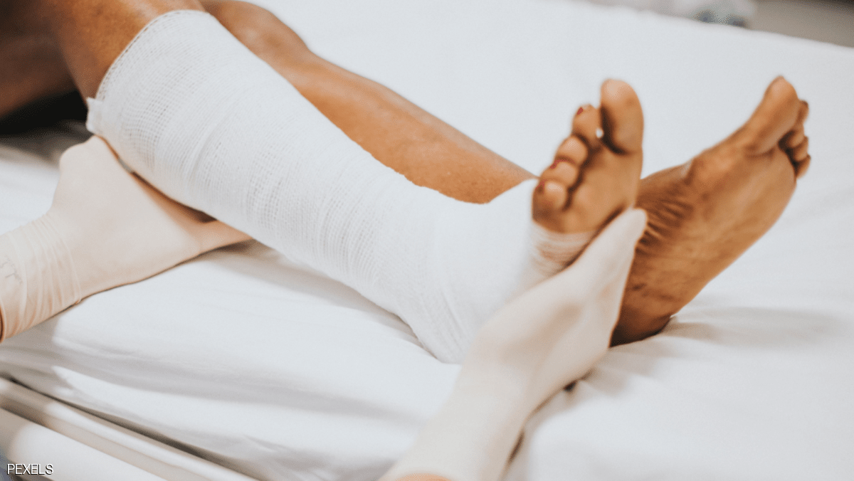 تقنية جديدة للتخلص من تجلطات الساق