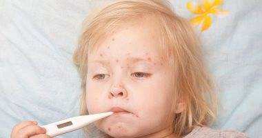 أمريكا تسجل أعلى عدد لحالات الحصبة منذ القضاء على الفيروس عام 2000