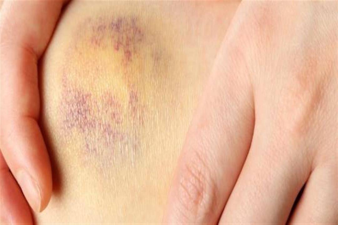 3 أسباب لظهور الكدمات المفاجئة.. إليك طرق علاجها