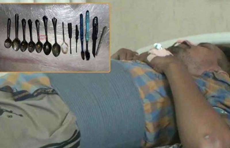 استخراج ملاعق وسكين ومفكّين وقفل من معدة مريض.. والسر!