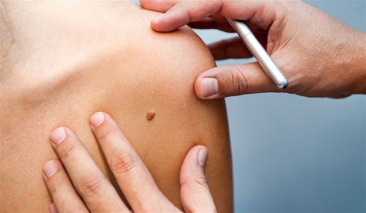 الأورام الجلدية الحميدة... في أي حالة يجب إزالتها؟