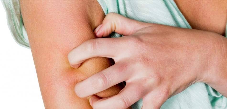 حلول منزلية تحمي من لدغات البعوض.. تعرّفوا اليها!