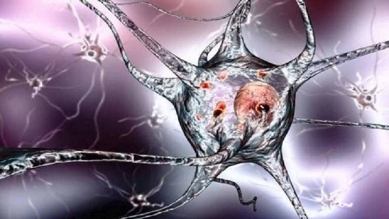 أدلة جديدة تثبت أن مرض الشلل الرعاش يبدأ من الأمعاء