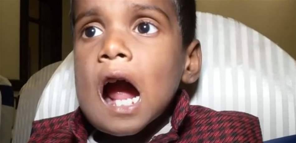 اقتلاع 526 سناً من فم طفل.. حالته نادرة!
