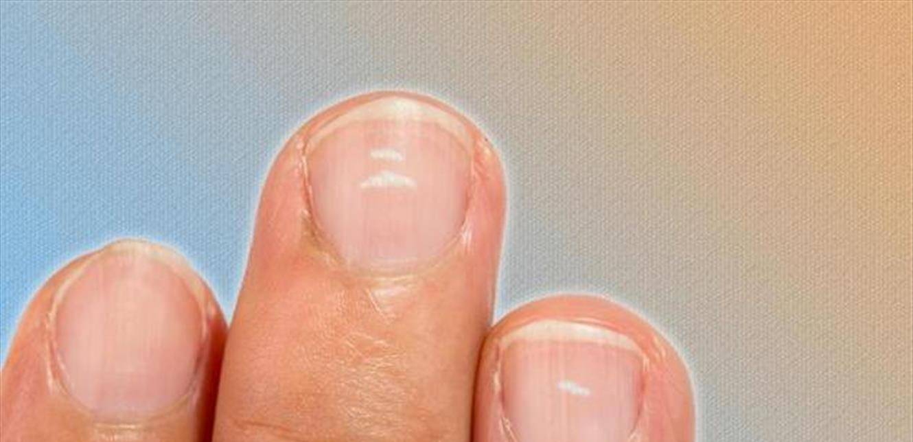 خطوط بيضاء على الأظافر وكدمات مفاجئة.. استشر الطبيب فوراً!