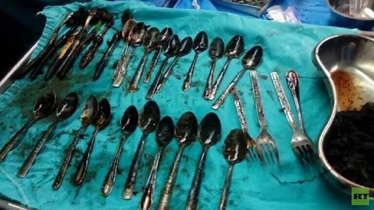بالصور.. استخراج عدد كبير من الملاعق ومواد معدنية أخرى من معدة مصري