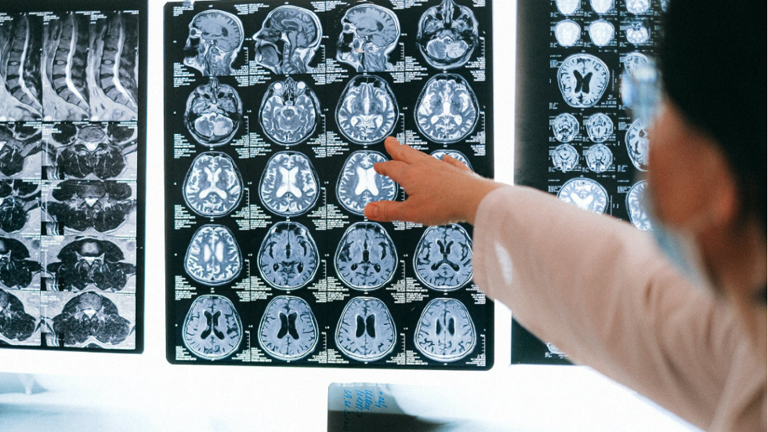 عمليات مسح الدماغ تظهر مجموعة كاملة من تشوهات 