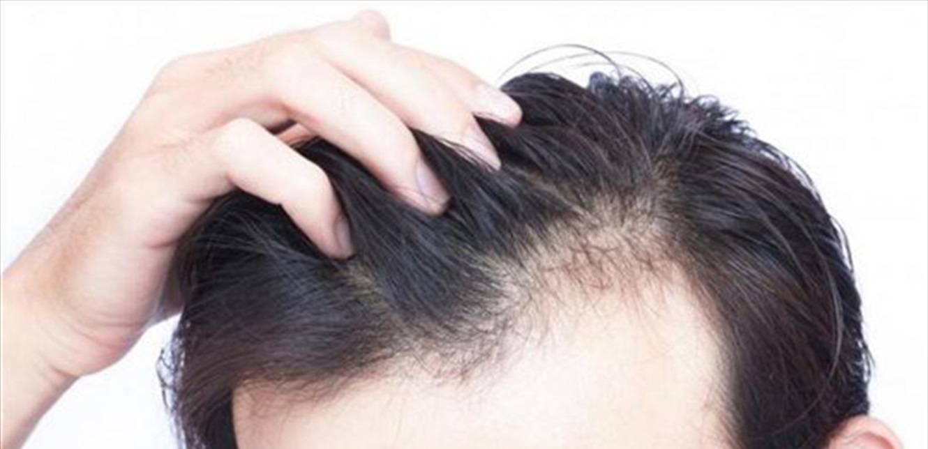 الخطأ في اختيار نوعية الشامبو يؤدّي إلى قشرة في الرأس