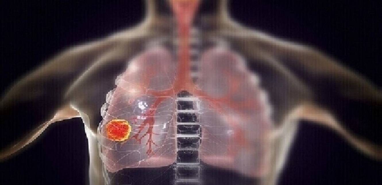 سرطان الرئة وخمس علامات تحذيرية 