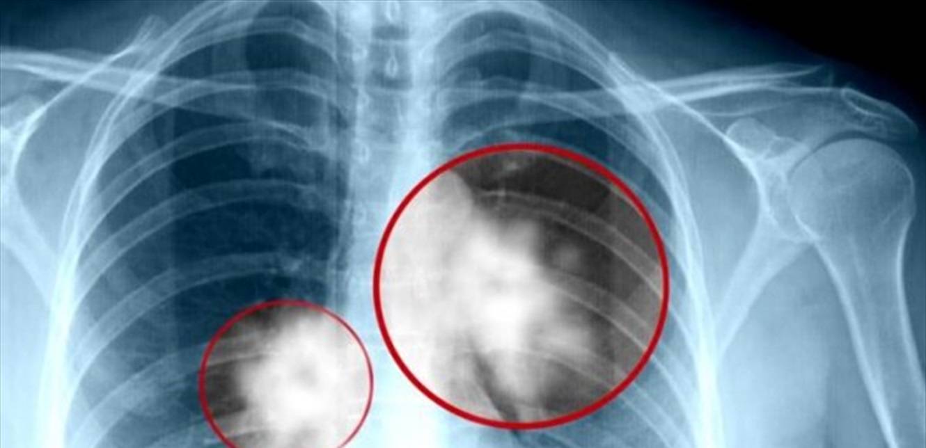 مرض خبيث قاتل.. هذه أعراض سرطان الرئة
