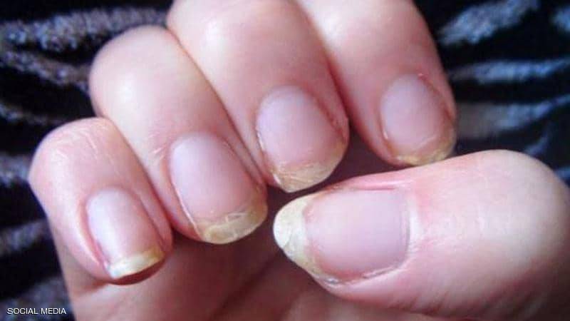 الألمان يبتكرون طريقة لكشف السرطان من حالة الأظافر