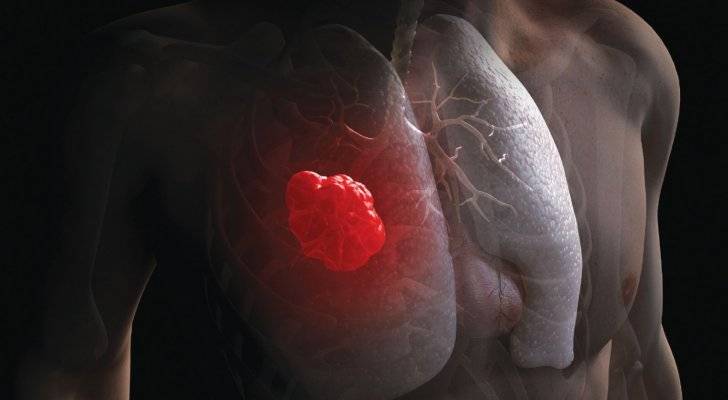 ممثلة عالمية تكافح سرطان الرئة لسبب عائلي
