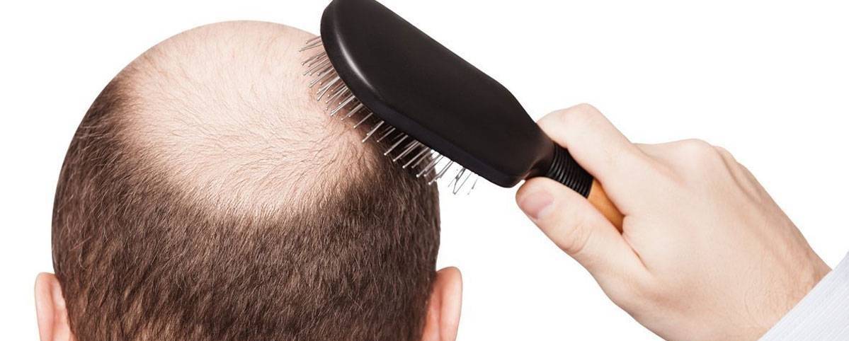 ما هي أسباب تساقط الشعر وكيفية علاجه؟
