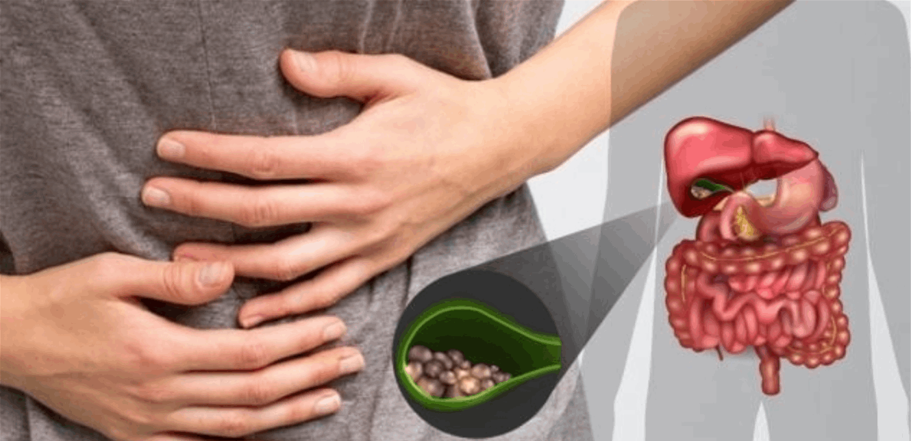 هذه الأطعمة تقلل الإصابة بحصوات المرارة