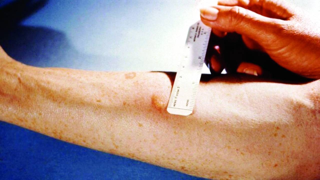 ظهور الشريان الأوسط في الساعد… على ماذا يدل؟