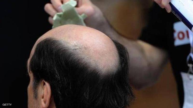 تمثل اضطرابا صحيا.. لا تتجاهل هذه العلامة في فروة الرأس