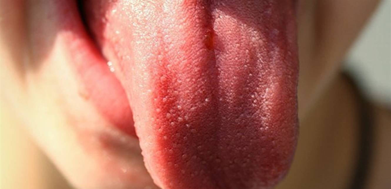دراسة تكشف عن خطر قاتل للبقع الظاهرة على لسان الإنسان