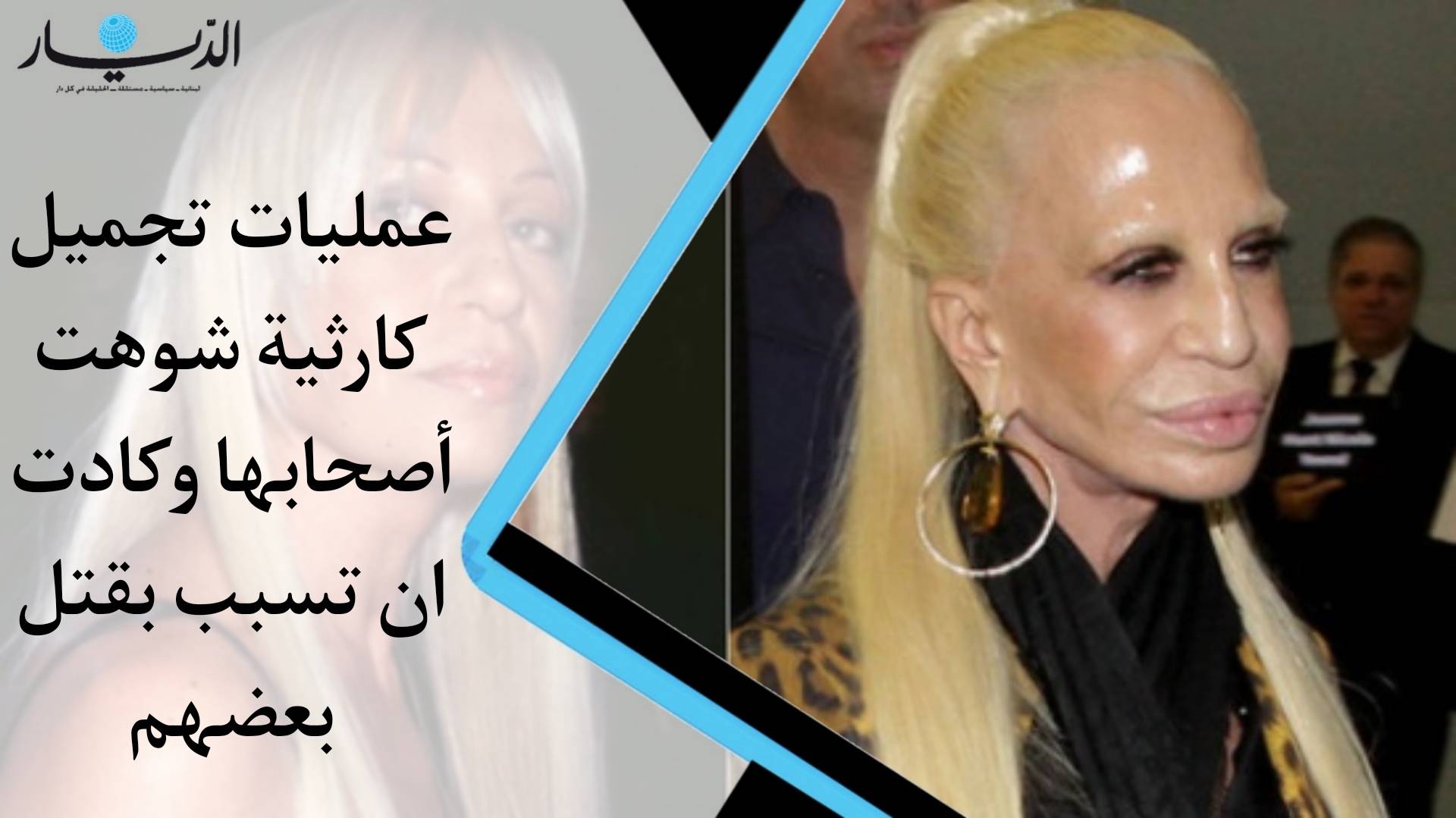 بالفيديو - عمليات تجميل كارثية شوهت أصحابها وكادت تتسبب بقتل بعضهم!