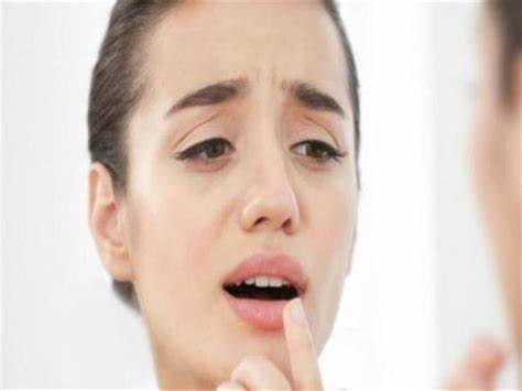 تشقق زوايا الفم..أكبر من مجرد مشكلة جمالية