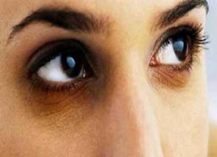 خلطة سحرية.. إزالة الهالات السوداء وانتفاخ تحت العين في أسبوع