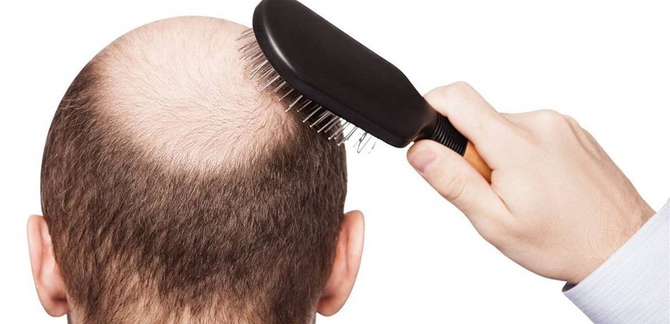 دواء يداوي مشكلتين لدى الرجال.. أشهرها تساقط الشعر
