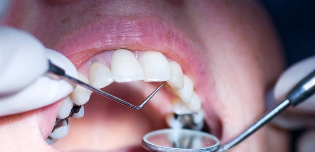 هذه الأطعمة  تؤدي الى تسوس الأسنان