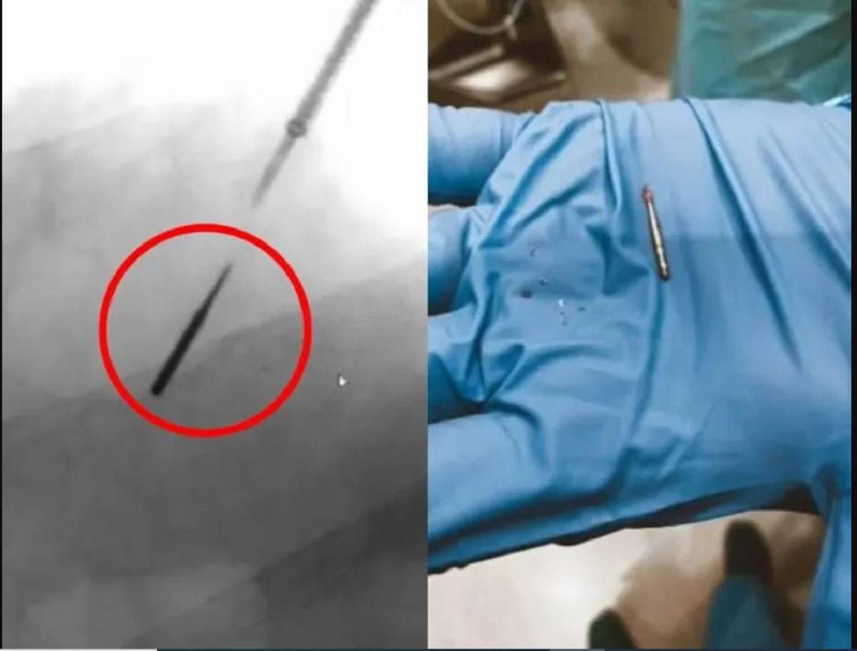 أداة حفر أسنان تدخل رئة مريض بطريقة غريبة