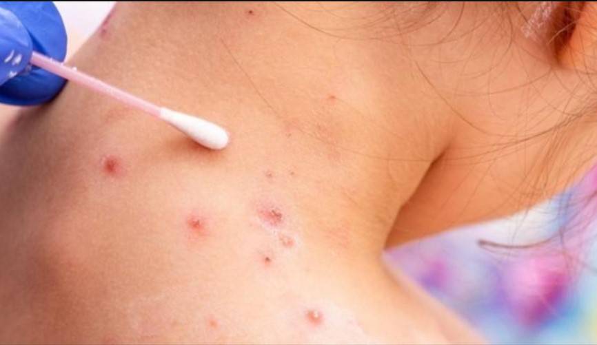 بالخطوات.. كيف تحمي نفسك من جدري القرود؟