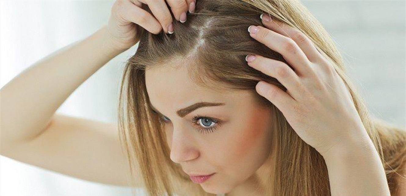 وداعاً لقشرة الرأس المحرجة.. إليكم 5 علاجات منزلية للوقاية منها