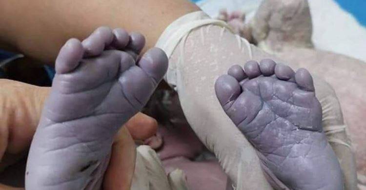 حالة نادرة في العراق... ولادة طفلة  بــ 24 إصبعاً!