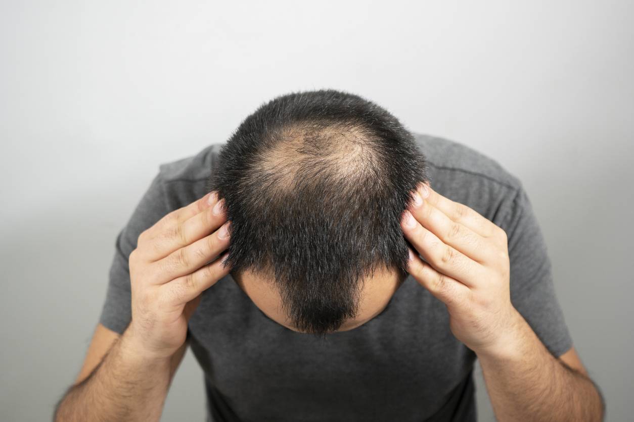 حقائق مهمّة يجب أن تعرفها قبل القيام بعملية زرع الشعر