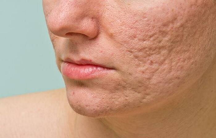 أكثروا من هذه الأغذية... وودّعوا حبّ الشباب