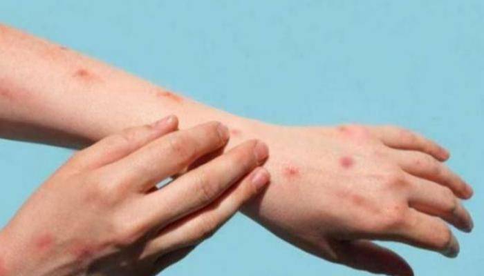 الصحة الإسبانية أعلنت عن ثاني حالة وفاة بجدري القردة
