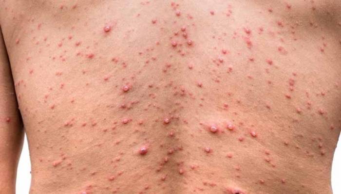 كاليفورنيا تعلن حالة الطوارئ بسبب تفشّي جدري القرود... وبايدن يعين منسقاً وطنياً للمرض