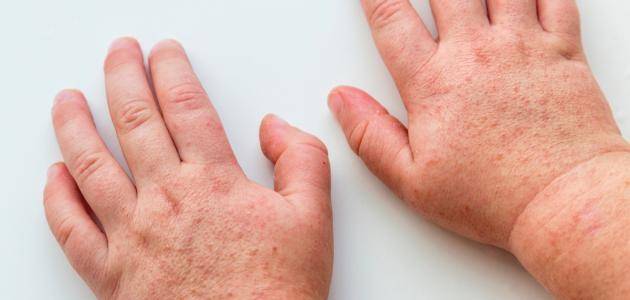 أمراض «تاريخيّة» تعود الى الواجهة.. إحذروها !