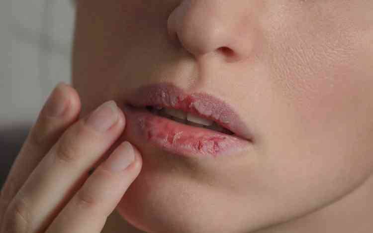 ما هي أسباب جفاف الفم؟ وما علاجه؟