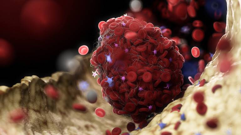 أطعمة يمكن أن "تذيب بشكل طبيعي" جلطات الدم المميتة