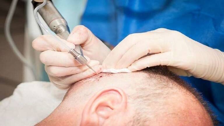 بالصورة- دخل لإجراء عملية زرع شعر فخرج جثة هامدة!