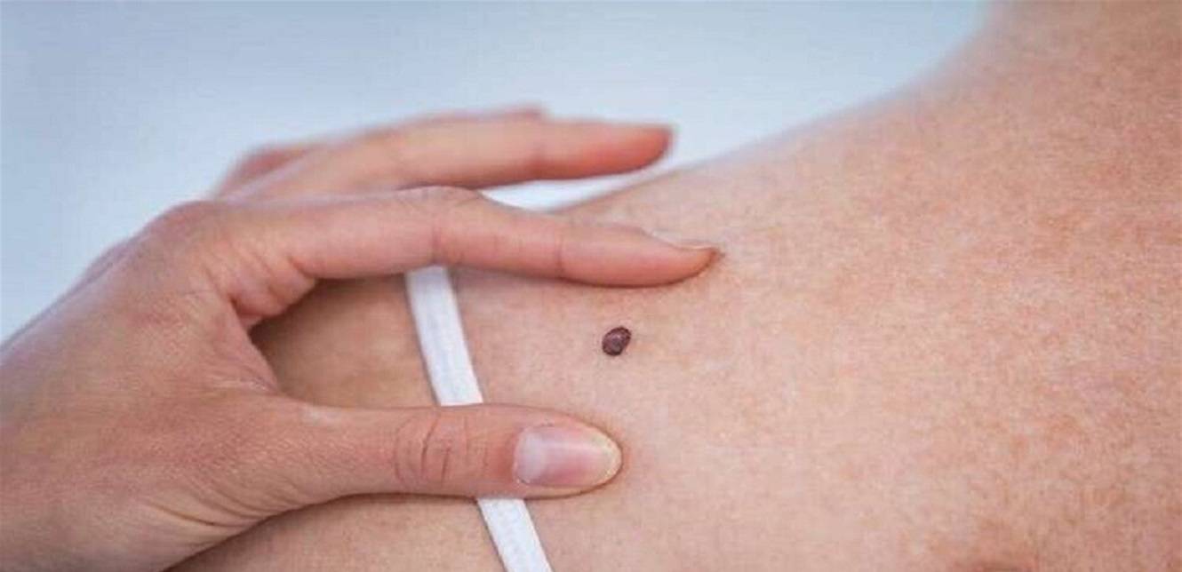 فاكهة قد تساعد في علاج سرطان الجلد... ما هي؟
