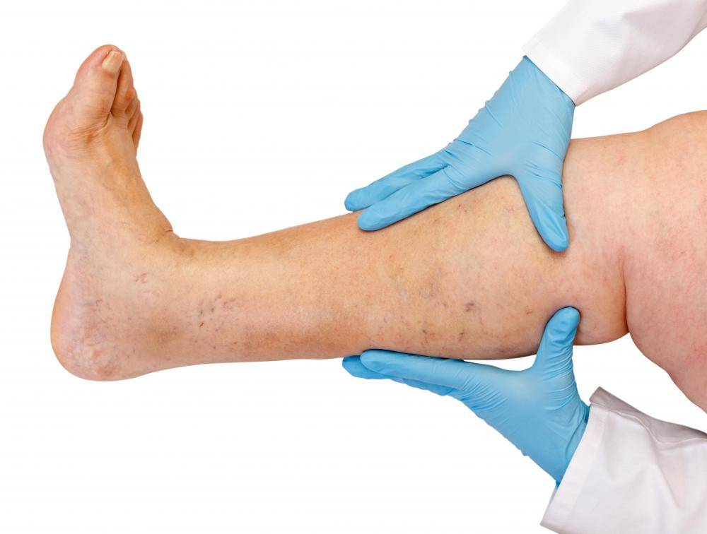 أعراض مرتبطة بالجلطة الدموية... ما هي؟